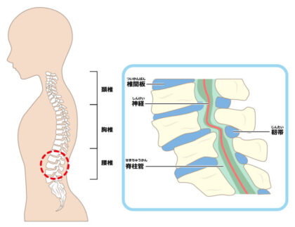 腰椎椎間板ヘルニア