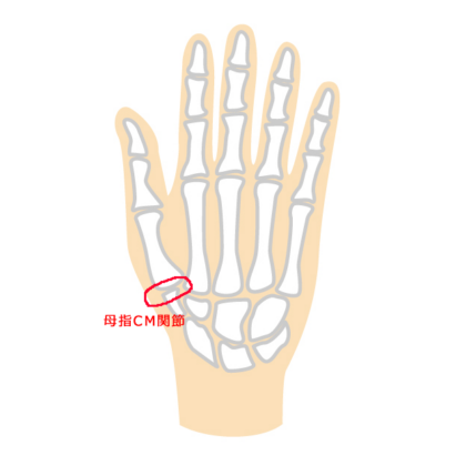 母指変形性CM関節症（ぼしへんけいせいしーえむかんせつしょう）