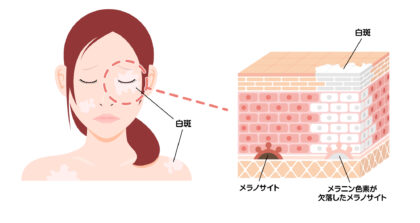 尋常性白斑の原因