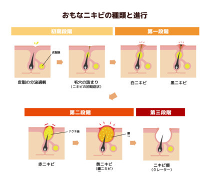 ニキビについて
