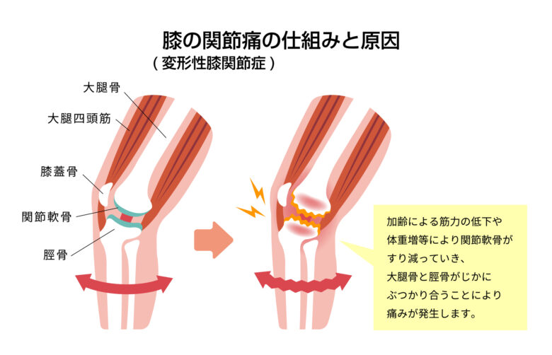 変形性膝関節症