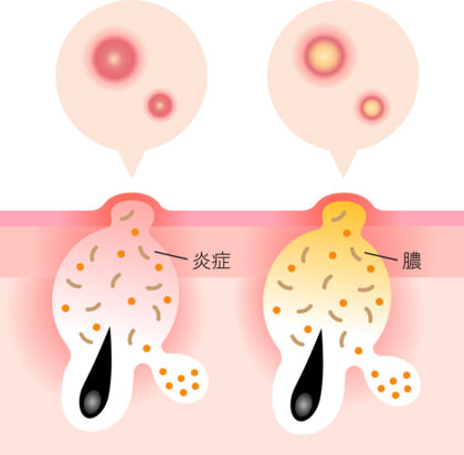 赤ニキビ・黄ニキビ