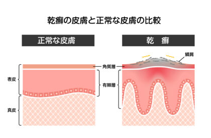 乾癬