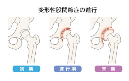 変形性膝関節症