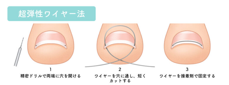 ワイヤー法（自費診療）