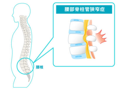 腰部脊柱管狭窄症